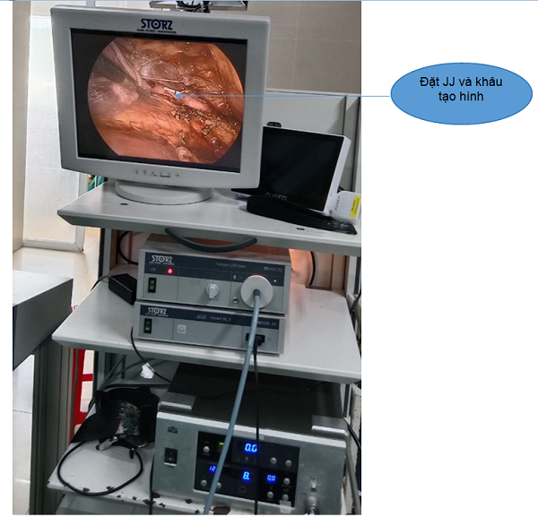 Phẫu thuật nội soi tạo hình hẹp khúc nối bể thận - niệu quản tại Bệnh viện Đa khoa tỉnh Ninh Bình.